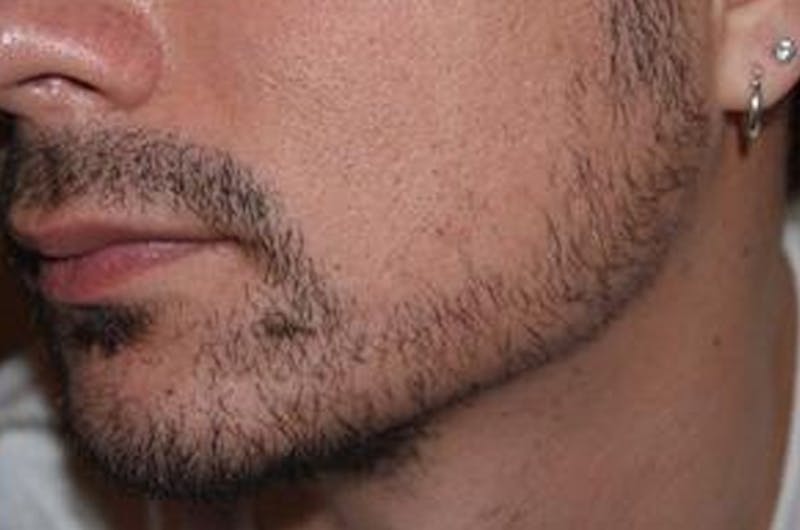 Facial Hair Transplant Before & After Gallery - Patient 148511 - Image 4