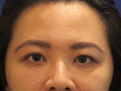 Eyebrow Transplantation Before & After Gallery - Patient 636838 - Image 2