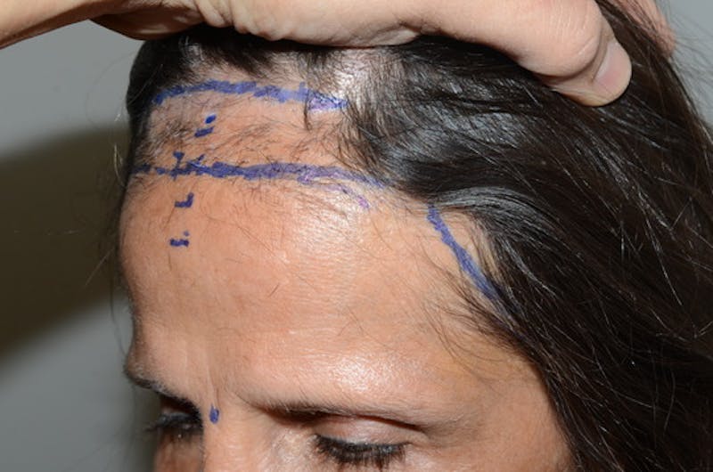Hair Transplant Repair Before & After Gallery - Patient 230169 - Image 1