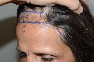 Hair Transplant Repair Before & After Gallery - Patient 595712 - Image 1