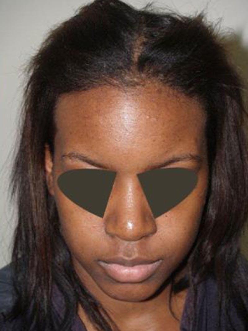 Hair Procedures for Women Before & After Gallery - Patient 242963 - Image 2