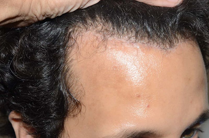 Hair Restoration for Men Before & After Gallery - Patient 439998 - Image 6
