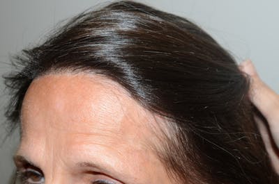 Hairline Lowering Surgery Before & After Gallery - Patient 143834 - Image 2