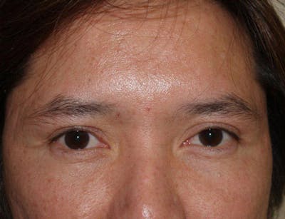 Eyebrow Transplantation Before & After Gallery - Patient 120468 - Image 1