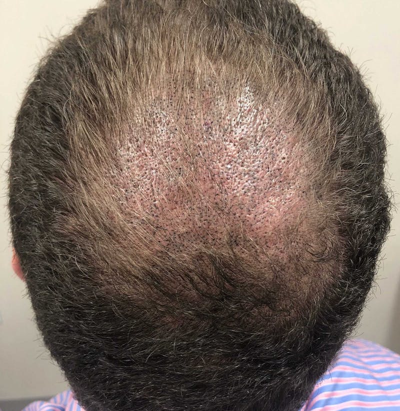 Scalp Micropigmentation Procedures Before & After Gallery - Patient 386466 - Image 2