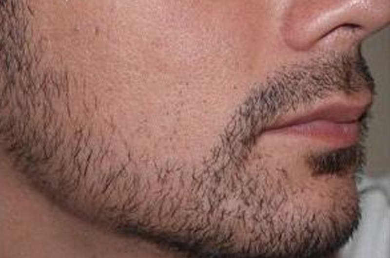 Facial Hair Transplant Before & After Gallery - Patient 148511 - Image 6