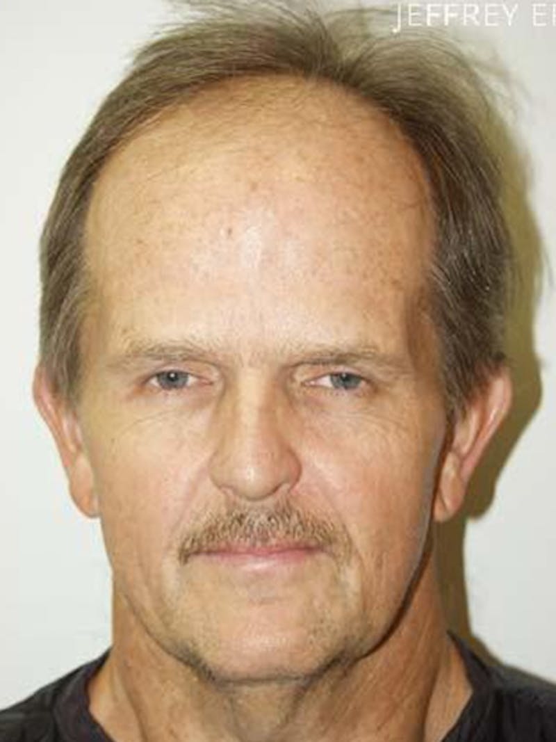 Hair Restoration for Men Before & After Gallery - Patient 108244 - Image 1