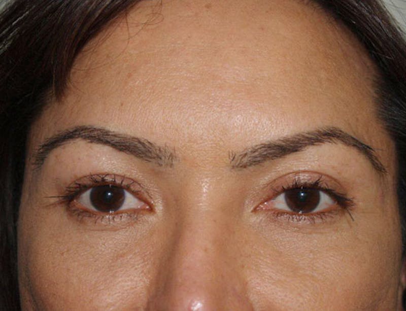 Eyebrow Transplantation Before & After Gallery - Patient 108278 - Image 2