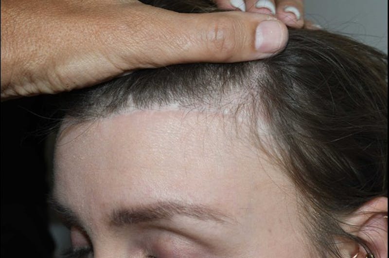 Hair Transplant Repair Before & After Gallery - Patient 127609 - Image 1