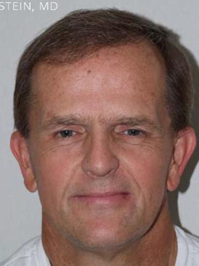 Hair Restoration for Men Before & After Gallery - Patient 108244 - Image 2