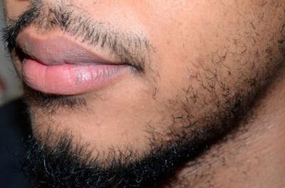 Facial Hair Transplant Before & After Gallery - Patient 146586 - Image 1