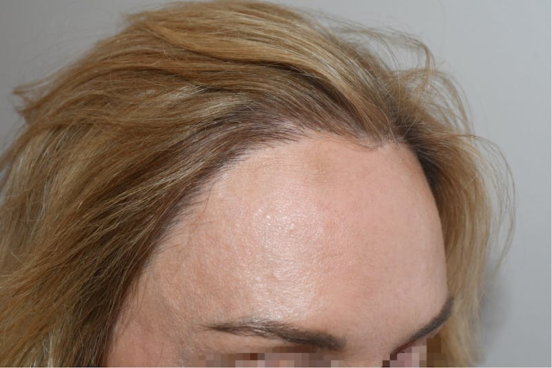 Special Cases Before & After Gallery - Patient 101485 - Image 4
