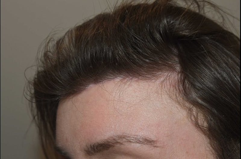 Hair Transplant Repair Before & After Gallery - Patient 127609 - Image 2