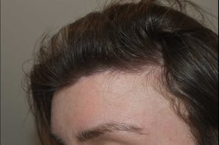 Hairline Lowering Surgery Before & After Gallery - Patient 425797 - Image 2