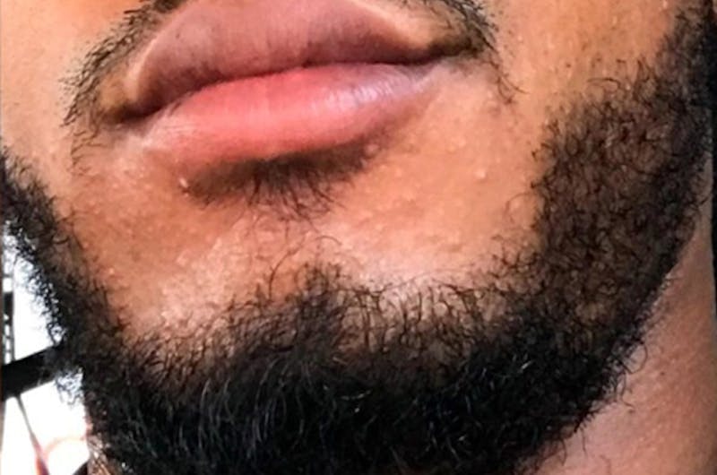 Facial Hair Transplant Before & After Gallery - Patient 970159 - Image 2