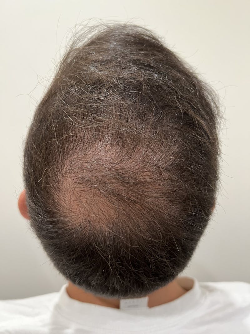 Scalp Micropigmentation Procedures Before & After Gallery - Patient 403534 - Image 1
