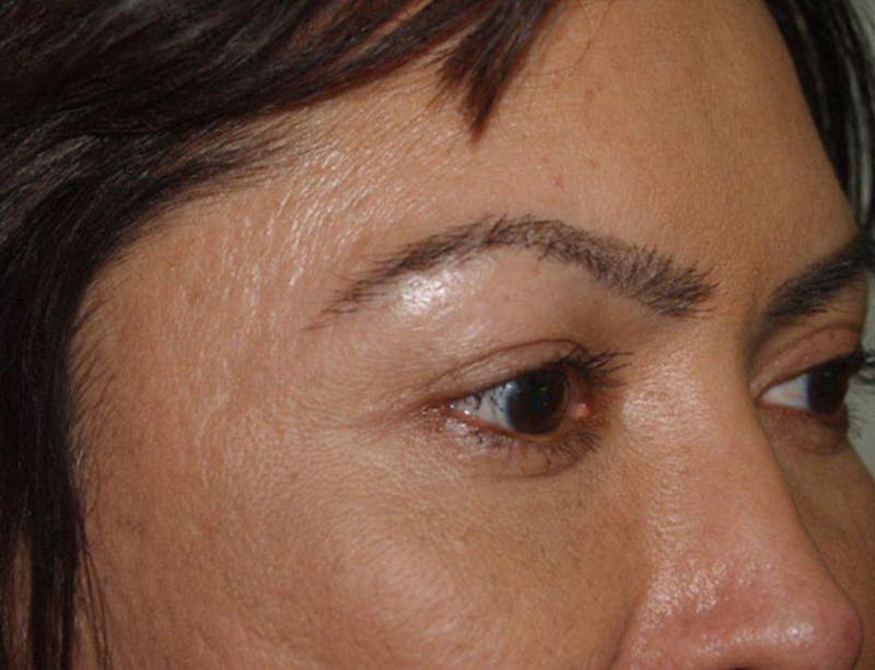 Eyebrow Transplantation Before & After Gallery - Patient 108278 - Image 4