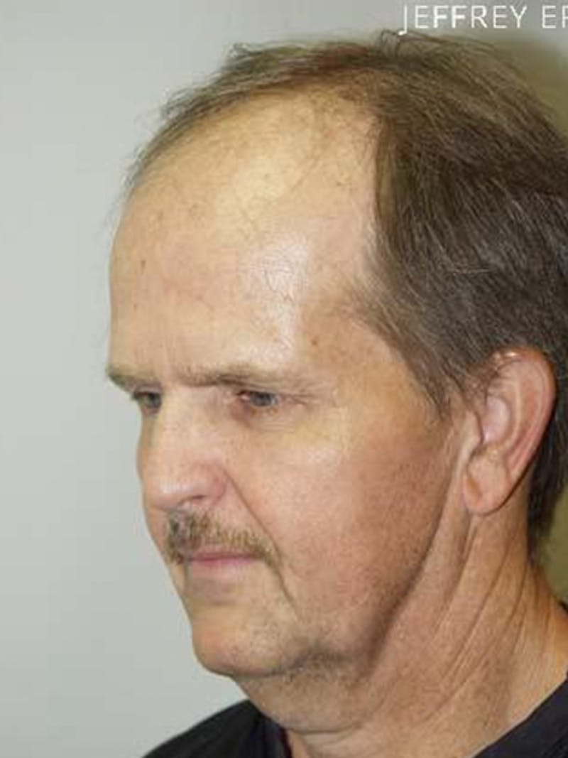 Hair Restoration for Men Before & After Gallery - Patient 108244 - Image 3