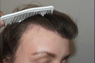 Hairline Lowering Surgery Before & After Gallery - Patient 425797 - Image 4