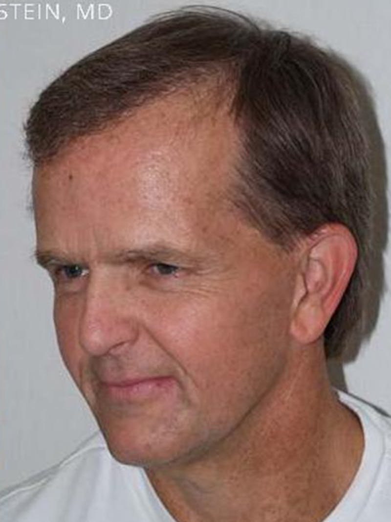 Hair Restoration for Men Before & After Gallery - Patient 108244 - Image 4