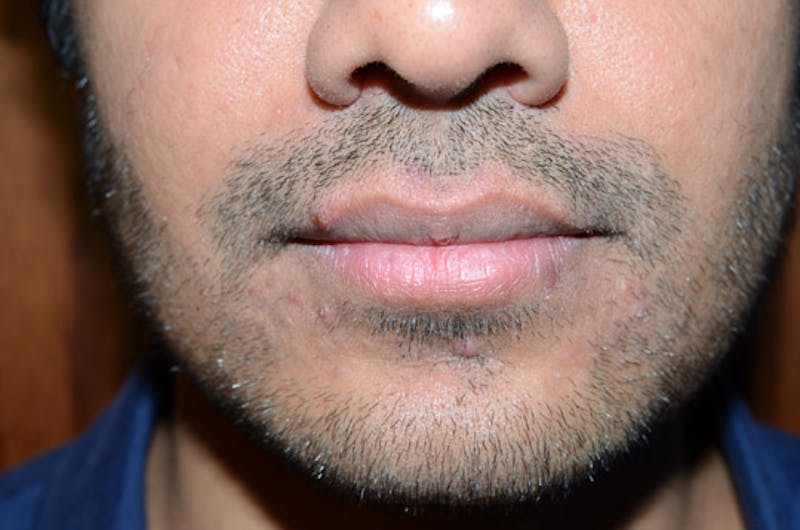 Facial Hair Transplant Before & After Gallery - Patient 260698 - Image 1