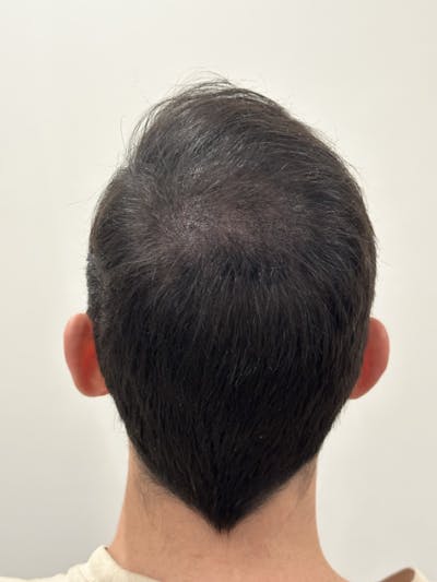 SMP Procedures Before & After Gallery - Patient 343374 - Image 2