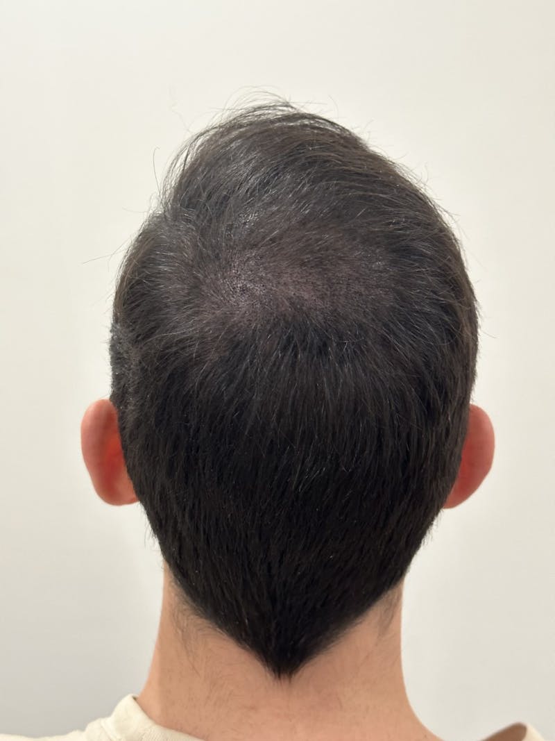 Scalp Micropigmentation Procedures Before & After Gallery - Patient 403534 - Image 2