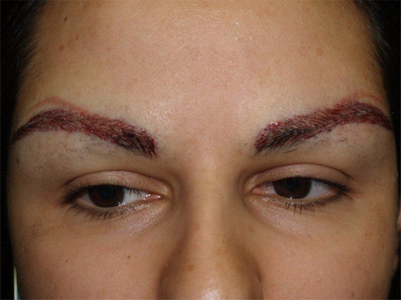 Eyebrow Transplantation Before & After Gallery - Patient 332491 - Image 2