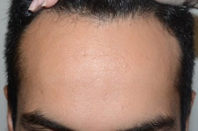 Hairline Lowering Surgery Before & After Gallery - Patient 108742 - Image 1
