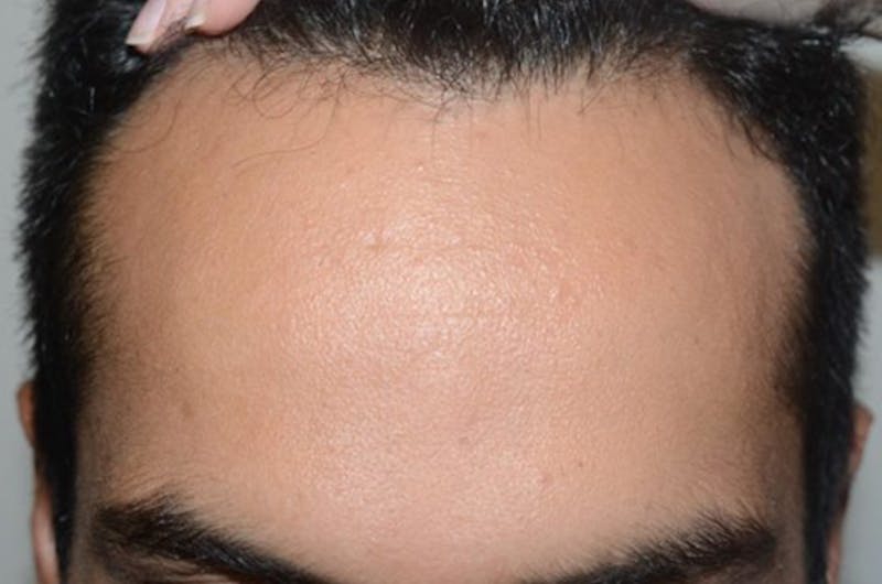 Hair Restoration for Men Before & After Gallery - Patient 419511 - Image 1