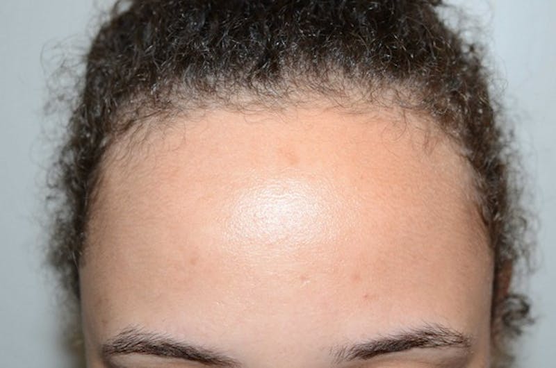 Hairline Lowering Surgery Before & After Gallery - Patient 110099 - Image 1