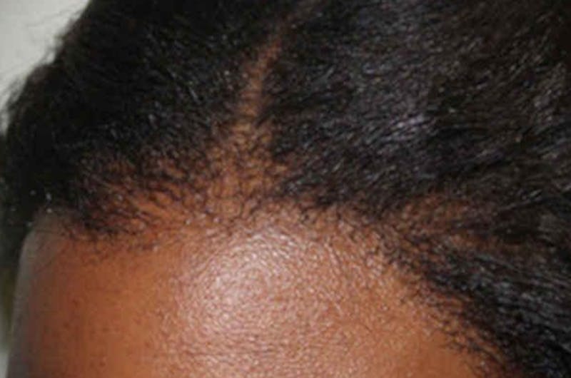Hair Procedures for Women Before & After Gallery - Patient 242963 - Image 8