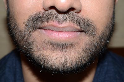 Facial Hair Transplant Before & After Gallery - Patient 928850 - Image 2