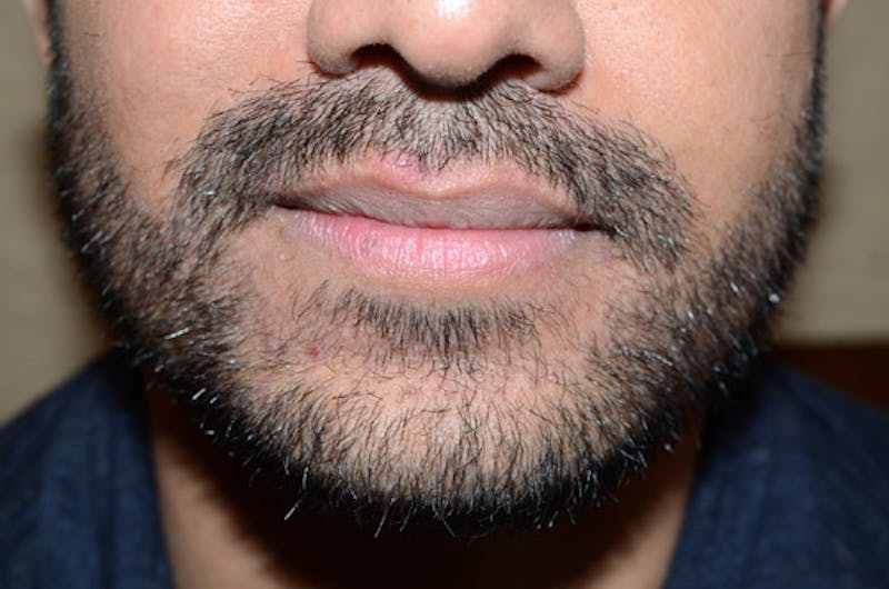 Facial Hair Transplant Before & After Gallery - Patient 260698 - Image 2