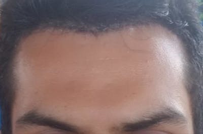 Hairline Lowering Surgery Before & After Gallery - Patient 108742 - Image 2