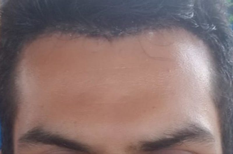 Hair Restoration for Men Before & After Gallery - Patient 419511 - Image 2