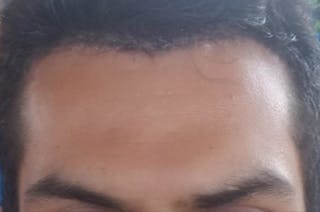 Hairline Lowering Surgery Before & After Gallery - Patient 831037 - Image 2