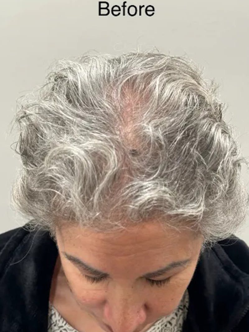 Scalp Micropigmentation Procedures Before & After Gallery - Patient 106786 - Image 1