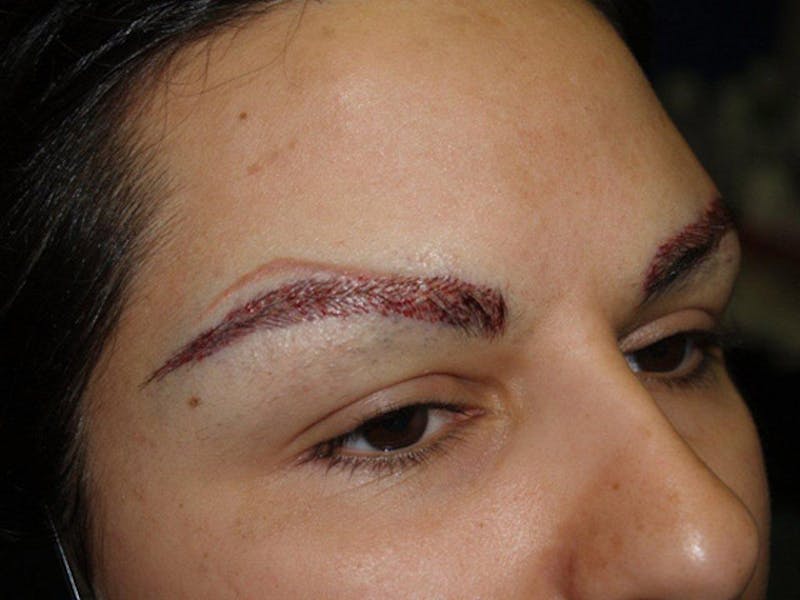 Eyebrow Transplantation Before & After Gallery - Patient 332491 - Image 4