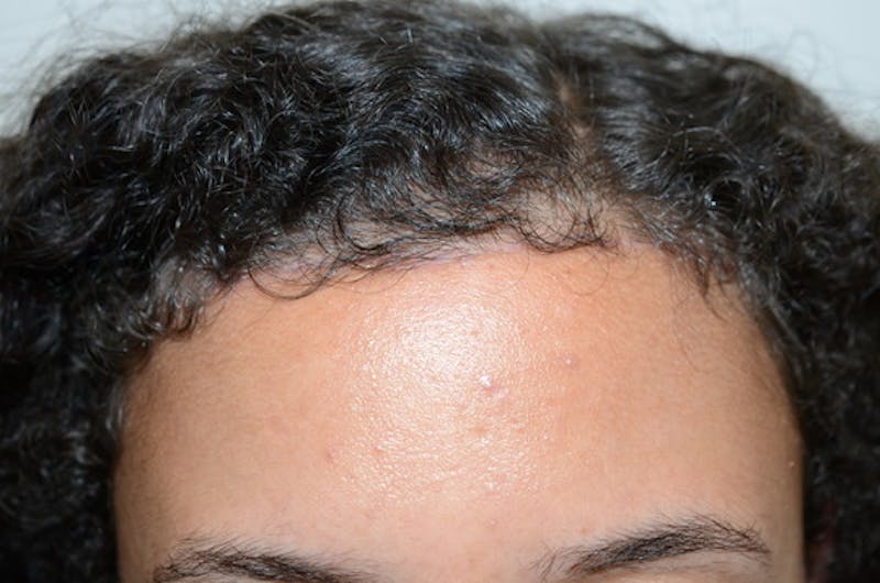 Hairline Lowering Surgery Before & After Gallery - Patient 110099 - Image 2