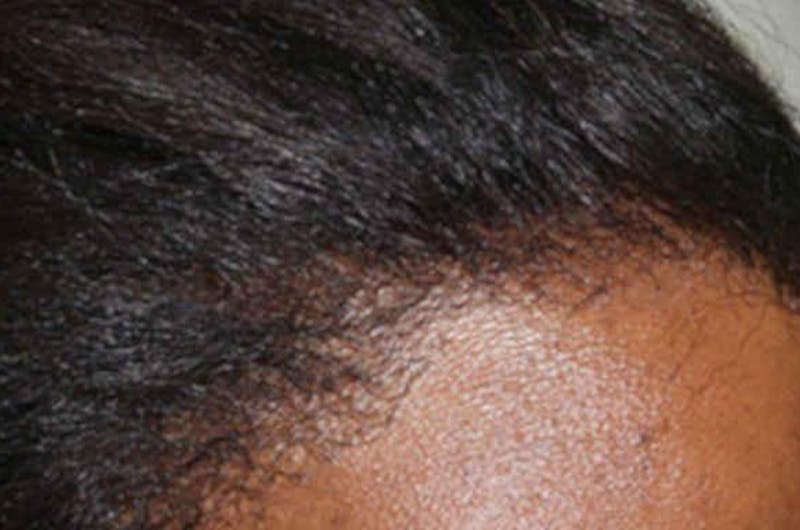 Hair Procedures for Women Before & After Gallery - Patient 242963 - Image 10