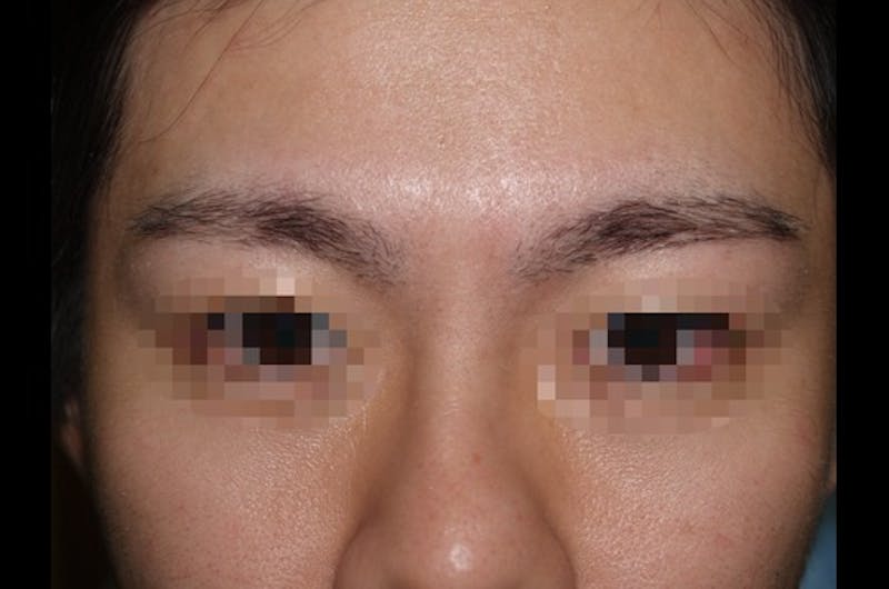 Eyebrow Transplantation Before & After Gallery - Patient 419012 - Image 1