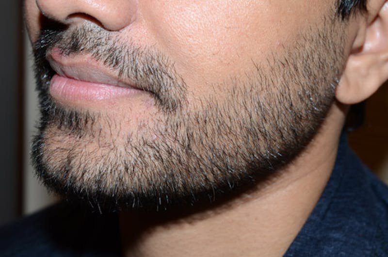 Facial Hair Transplant Before & After Gallery - Patient 260698 - Image 4