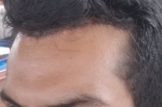 Hairline Lowering Surgery Before & After Gallery - Patient 831037 - Image 4