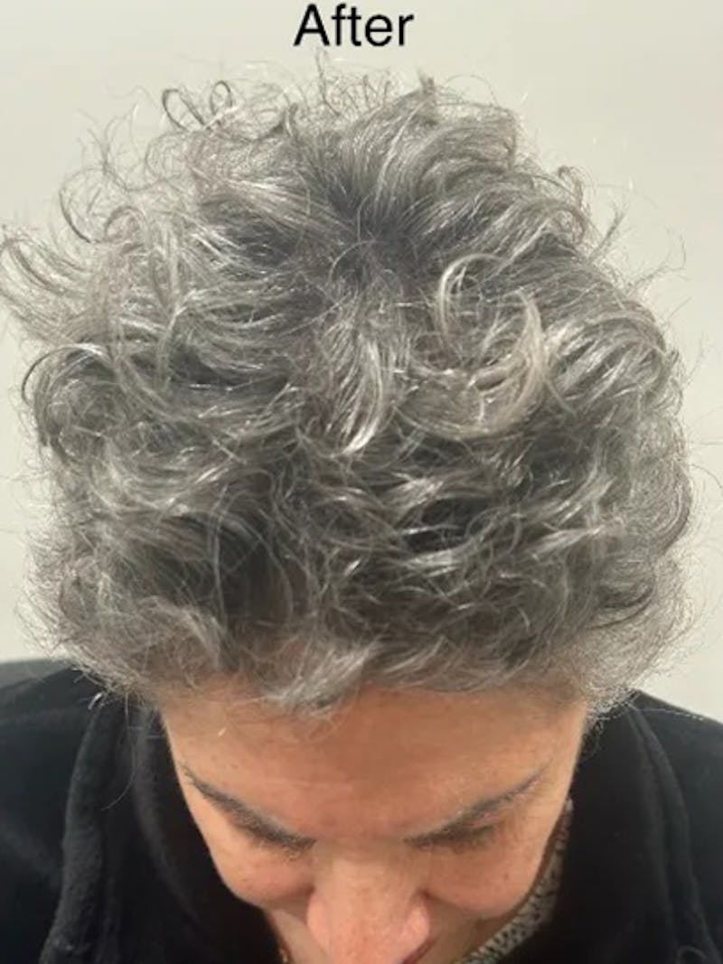 Scalp Micropigmentation Procedures Before & After Gallery - Patient 106786 - Image 2
