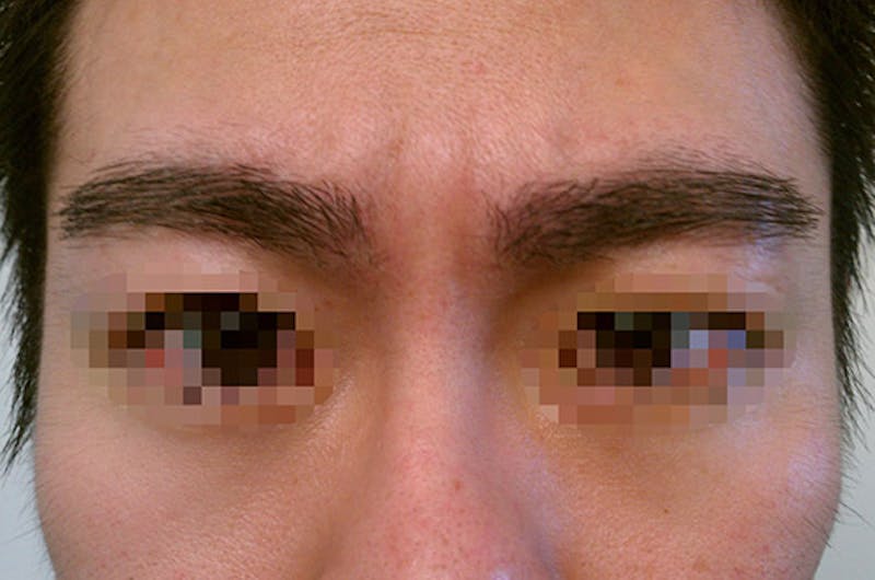Eyebrow Transplantation Before & After Gallery - Patient 419012 - Image 2