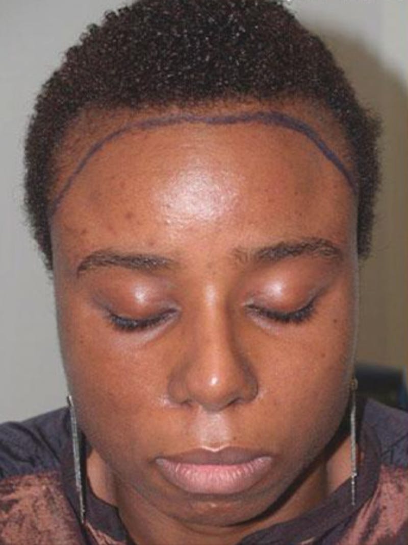 Hair Procedures for Women Before & After Gallery - Patient 369952 - Image 1