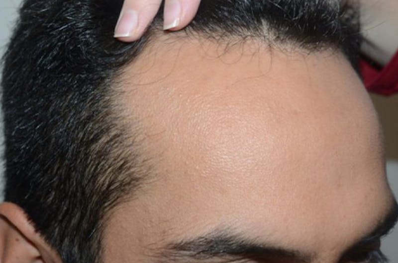 Hair Restoration for Men Before & After Gallery - Patient 419511 - Image 5