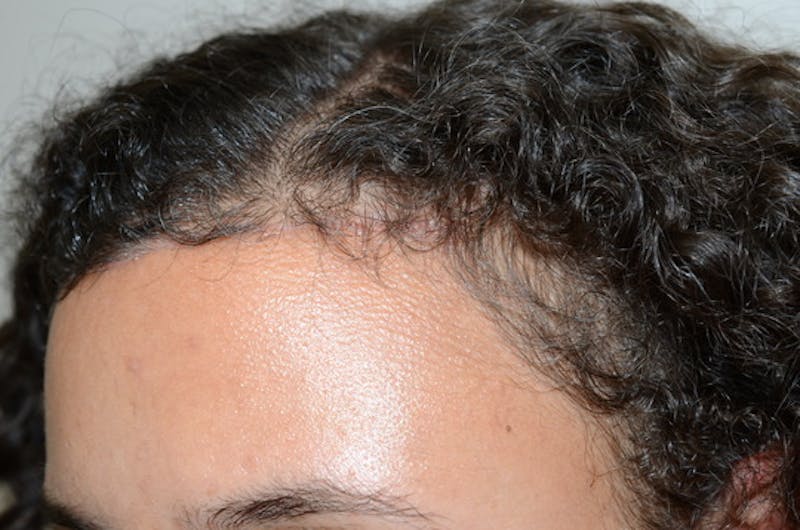 Hairline Lowering Surgery Before & After Gallery - Patient 110099 - Image 4
