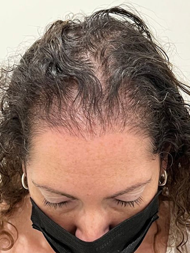 Scalp Micropigmentation Procedures Before & After Gallery - Patient 369227 - Image 1
